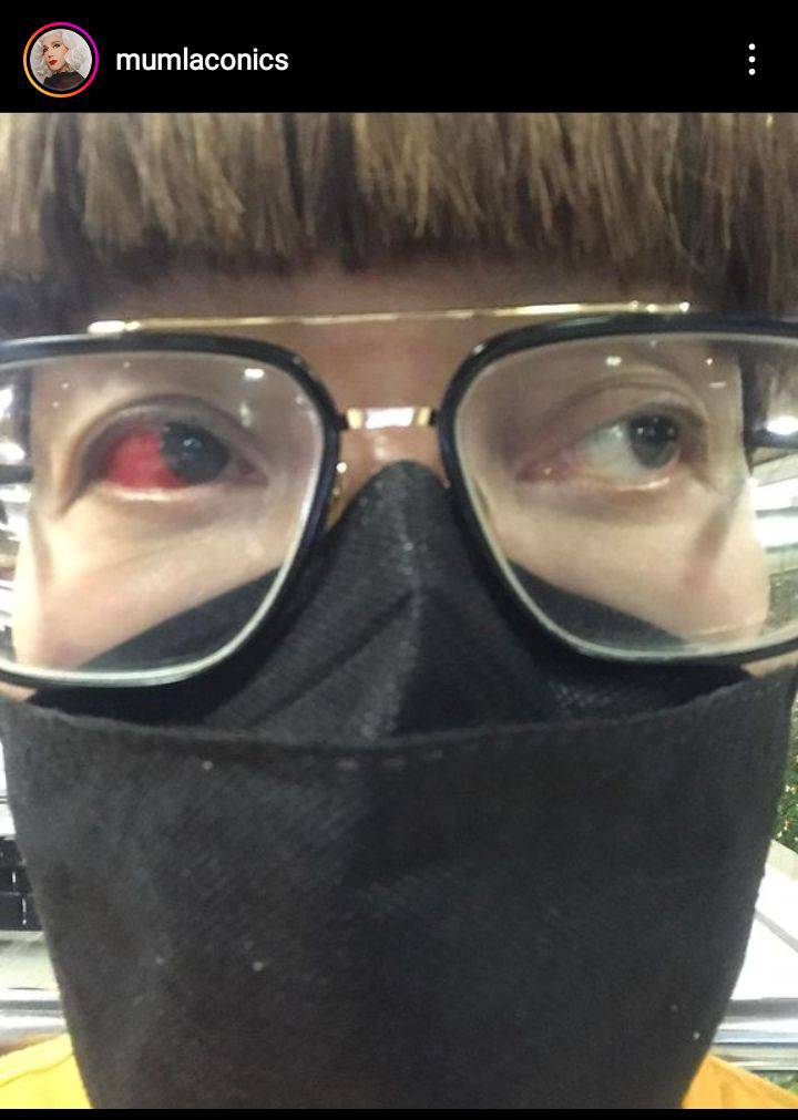 มัม ลาโคนิค พบคุณหมอแล้ว ยืนยัน เป็นเส้นเลือดฝอยในตาแตก มัม ลาโคนิค พบคุณหมอแล้ว ยืนยัน เป็นเส้นเลือดฝอยในตาแตก