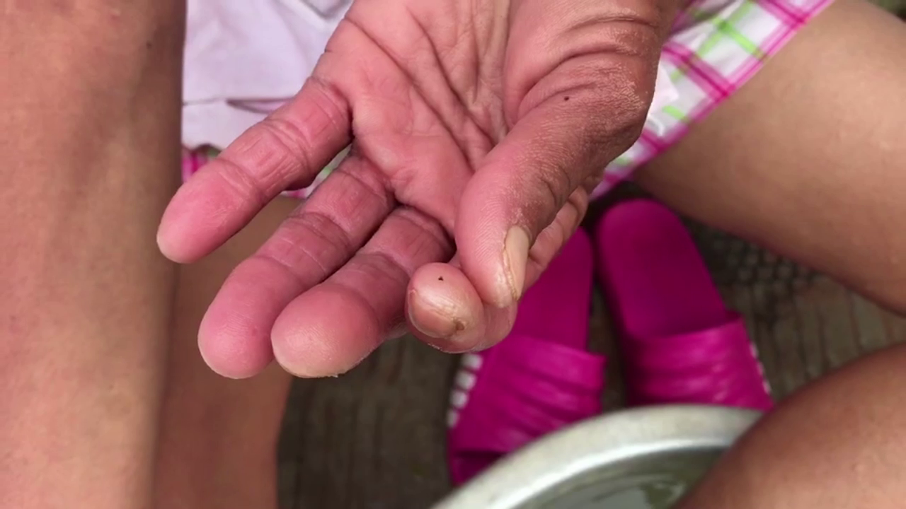 สาวใหญ่ป่วยโรคประหลาด! คล้ายหนอนโผล่ออกมาตามผิวหนัง สาวใหญ่ป่วยโรคประหลาด! คล้ายหนอนโผล่ออกมาตามผิวหนัง