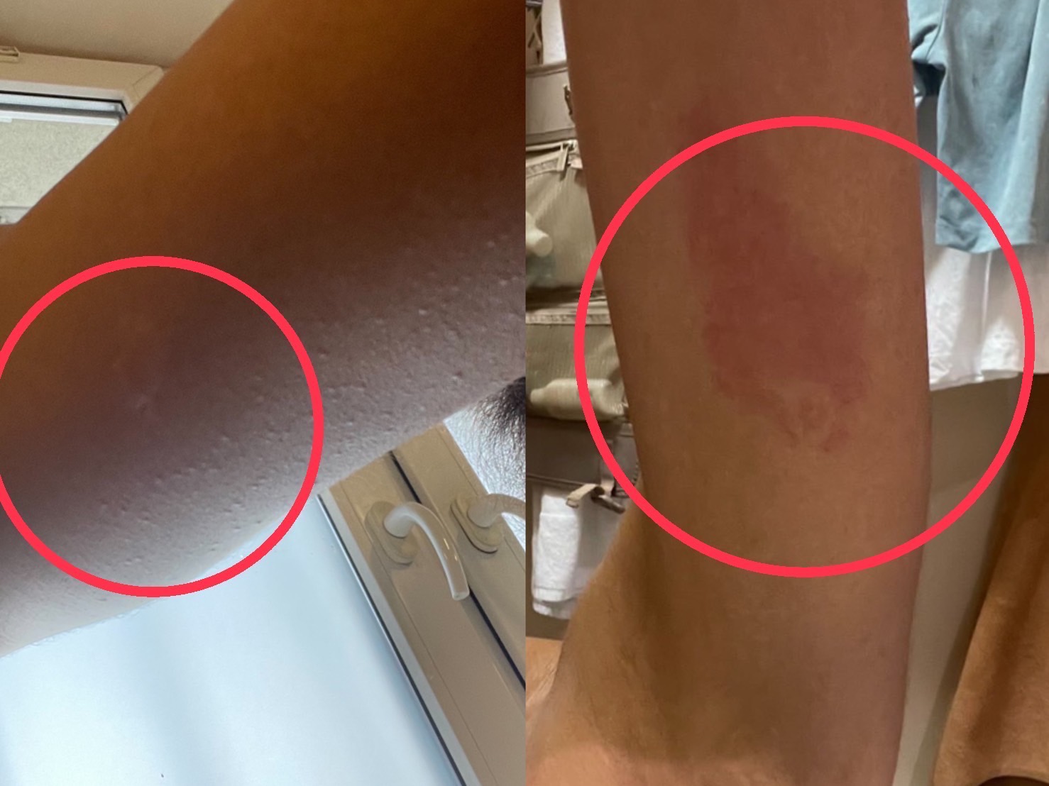 แพรว-แพรววณิชฐ์ มิส ซูปร้าฯ ไทย 2022 ถูกตัวแตนต่อย โร่หามโรงพยาบาลโปแลนด์