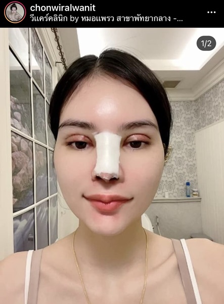 เอ๋ มิรา อัพความสวย ศัลยกรรมจมูก ตา และคาง เอ๋ มิรา อัพความสวย ศัลยกรรมจมูก ตา และคาง