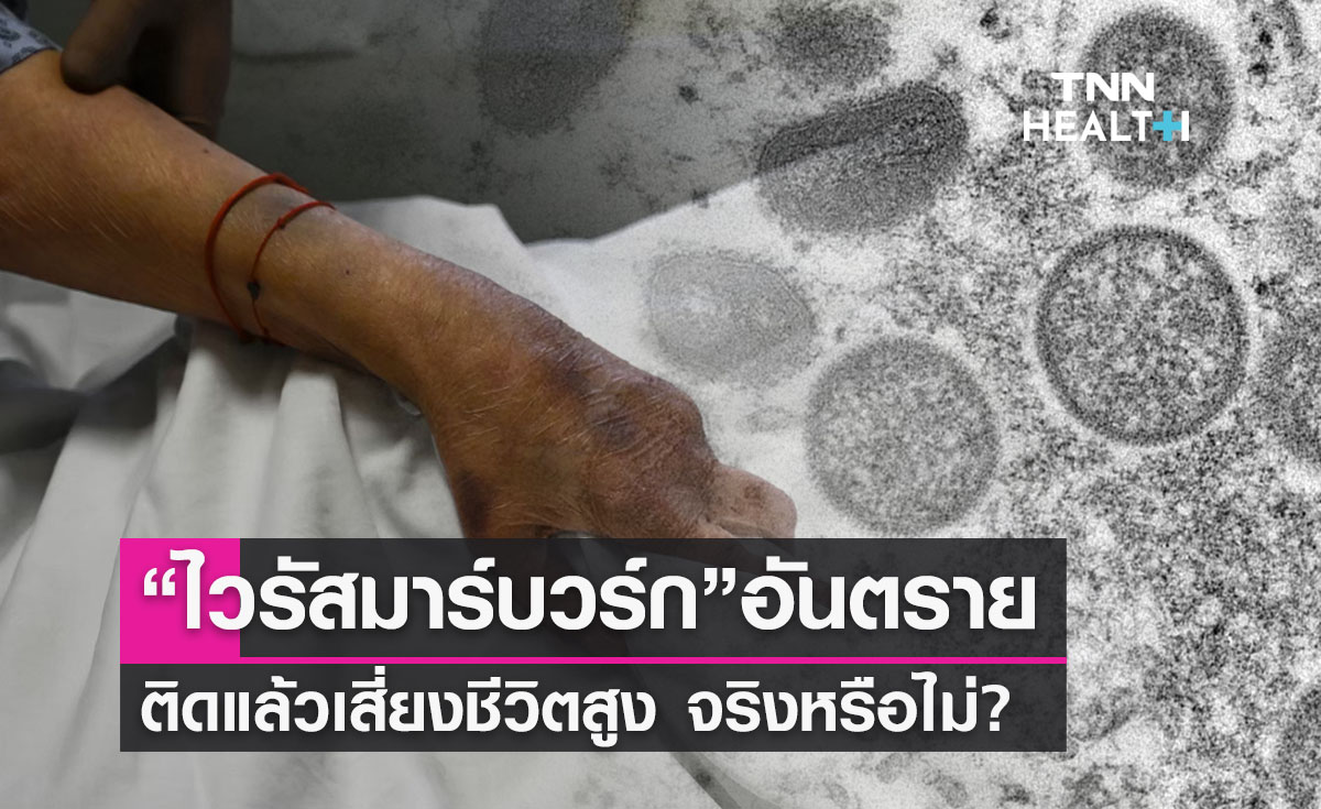 “ไวรัสมาร์บวร์ก” ติดต่อทางเลือด-อุจจาระ เสี่ยงเสียชีวิตสูง จริงหรือ? 