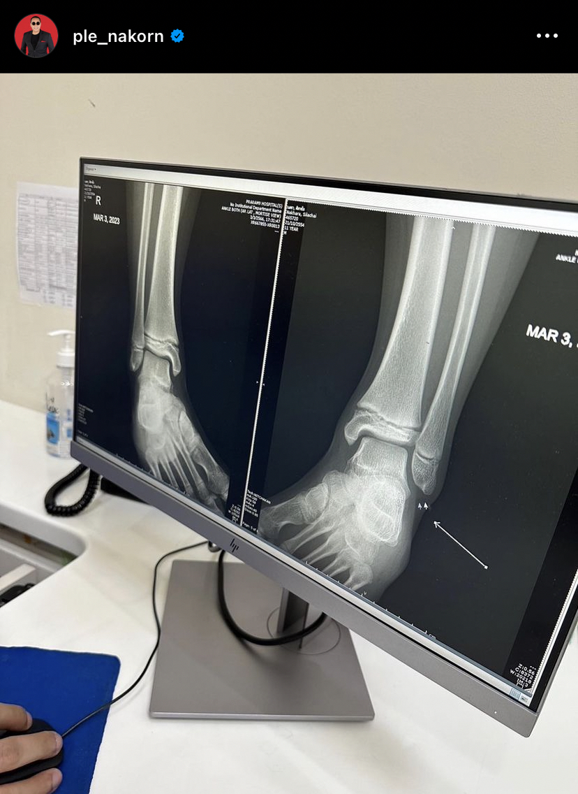 เปิ้ล นาคร ห่วงลูกชาย น้องออก้า หลังบาดเจ็บก่อนเตรียมลงแข่งเจ็ทสกี