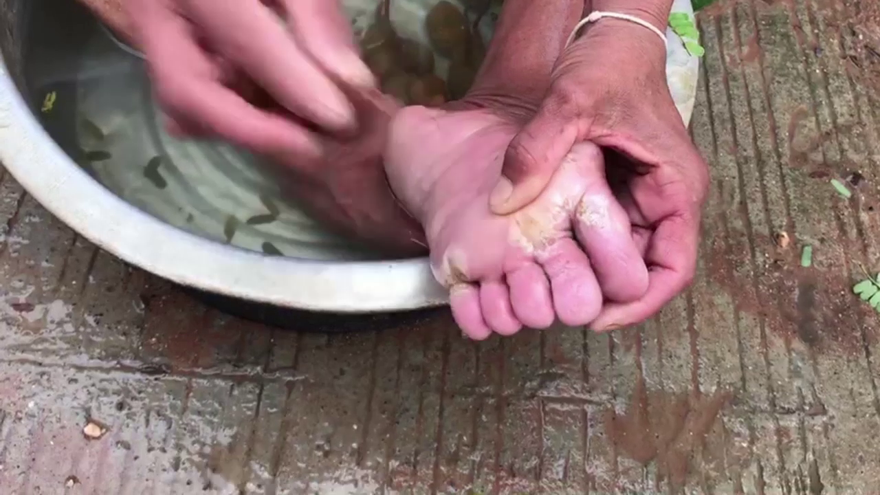 สาวใหญ่ป่วยโรคประหลาด! คล้ายหนอนโผล่ออกมาตามผิวหนัง สาวใหญ่ป่วยโรคประหลาด! คล้ายหนอนโผล่ออกมาตามผิวหนัง