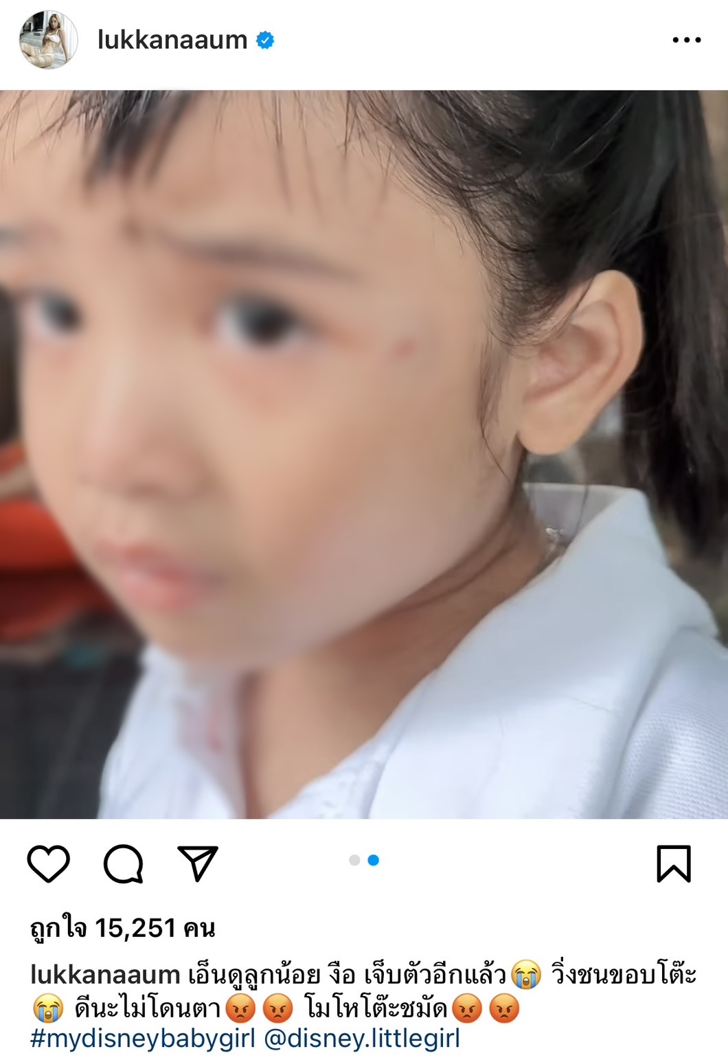 น้องดิสนีย์ ลูกสาว อุ้ม ลักขณา ได้รับบาดเจ็บ