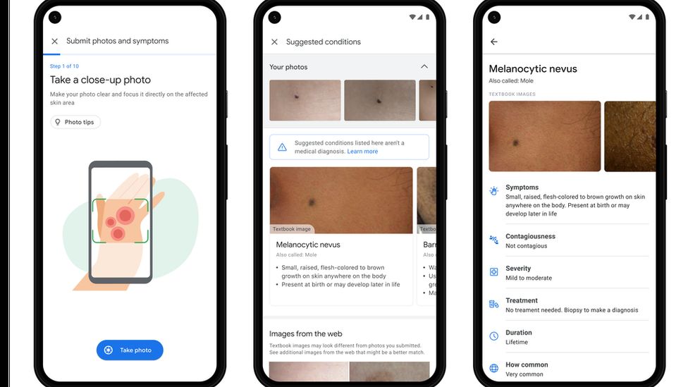 AI ช่วยวินิจฉัยโรคผิวหนัง เพียงอัปโหลดรูปภาพบน Google Image