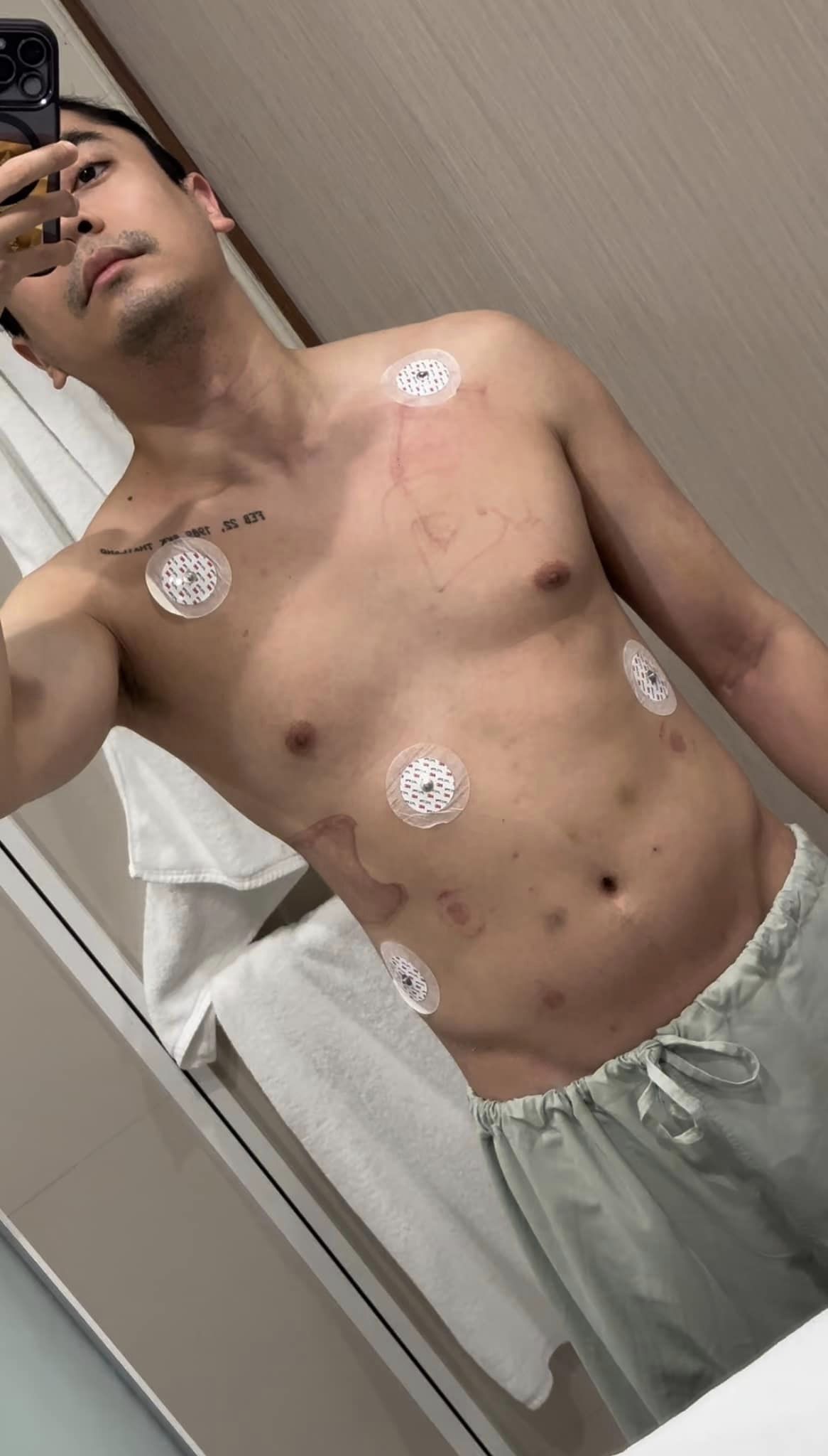 กีรติ ศุภดิเรกกุล แชร์ประสบการณ์เฉียดตาย หัวใจหยุดเต้น 19 นาที กีรติ ศุภดิเรกกุล แชร์ประสบการณ์เฉียดตาย หัวใจหยุดเต้น 19 นาที