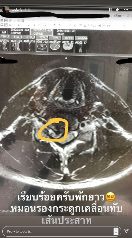 ท็อป จรณ กลัวเป็นอัมพฤกษ์ หลังหมอนรองกระดูกกดทับเส้นประสาทรุนแรง