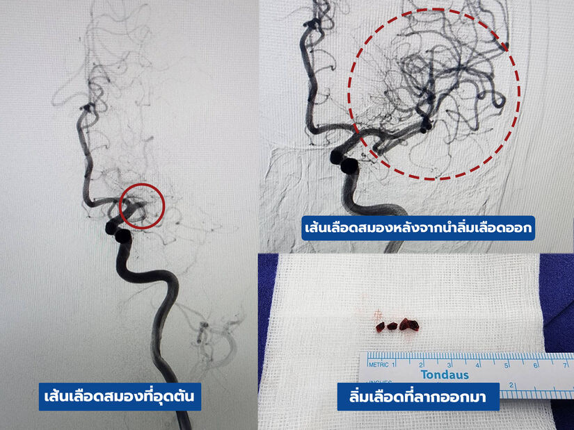 ลากลิ่มเลือด ฟื้นคืนสมอง การรักษาเส้นเลือดสมองอุดตันที่แม่นยำ ลากลิ่มเลือด ฟื้นคืนสมอง การรักษาเส้นเลือดสมองอุดตันที่แม่นยำ