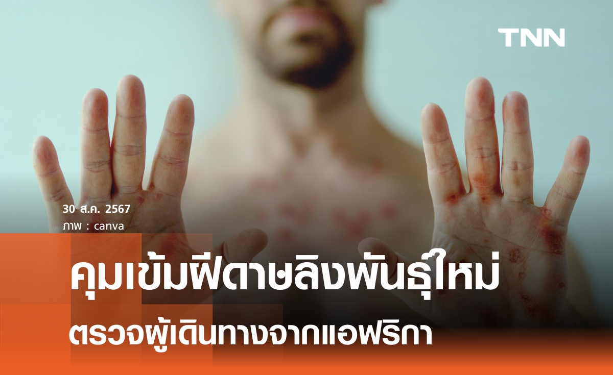 เฝ้าระวัง"ฝีดาษลิง"ผู้เดินทางจากแอฟริกาวันละ 300 คน 