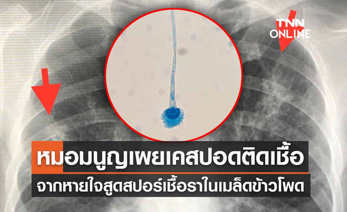 หมอมนูญเผยเคสผู้ป่วยหายใจสูดเชื้อราในข้าวโพด "ปอดติดเชื้อ" รักษากันยาว
