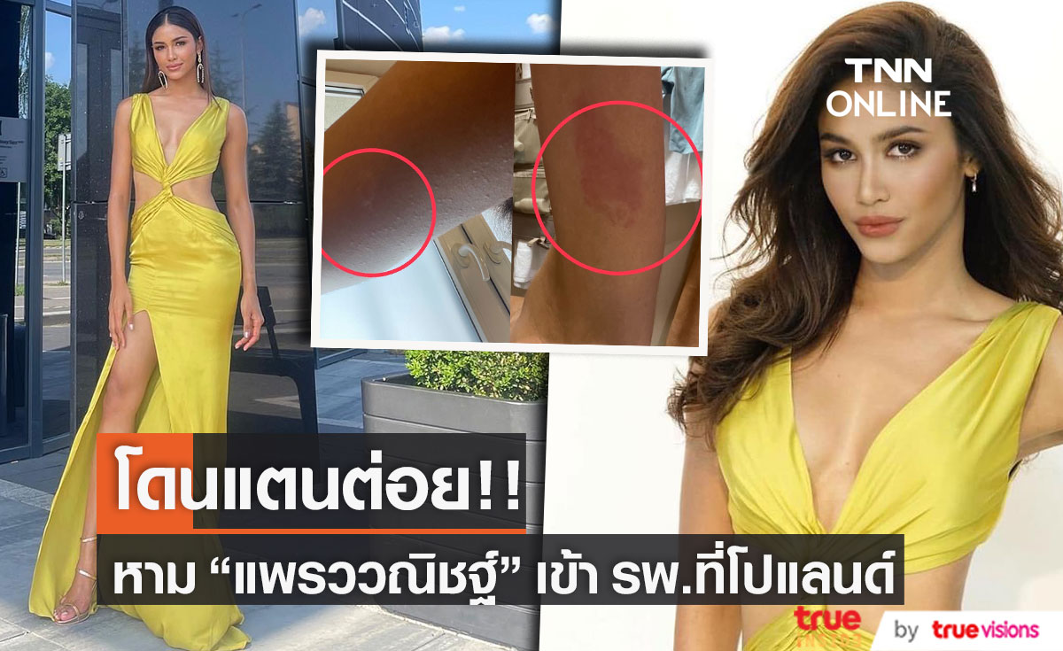 "แพรว แพรววณิชฐ์" มิสซูปร้าเนชันแนลไทยแลนด์ 2022 ถูกตัวแตนต่อย โร่หามโรงพยาบาลโปแลนด์