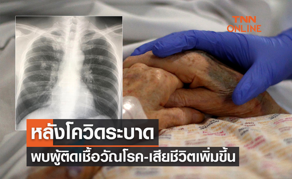 โควิดระบาด พบผู้ติดเชื้อวัณโรค-เสียชีวิตเพิ่มขึ้นในรอบ 20 ปี
