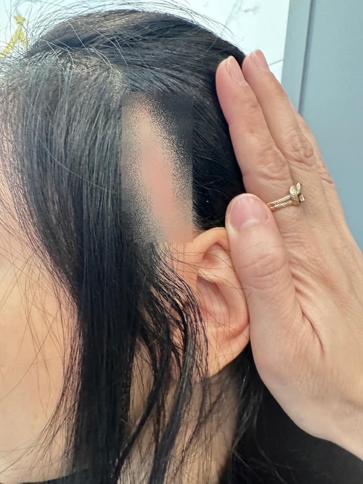 ศัลยกรรมสยอง! น้ำเพชร ฏีญาร์ภา หนังศรีษะเปิด หลังขึ้นเขียงทำสวย