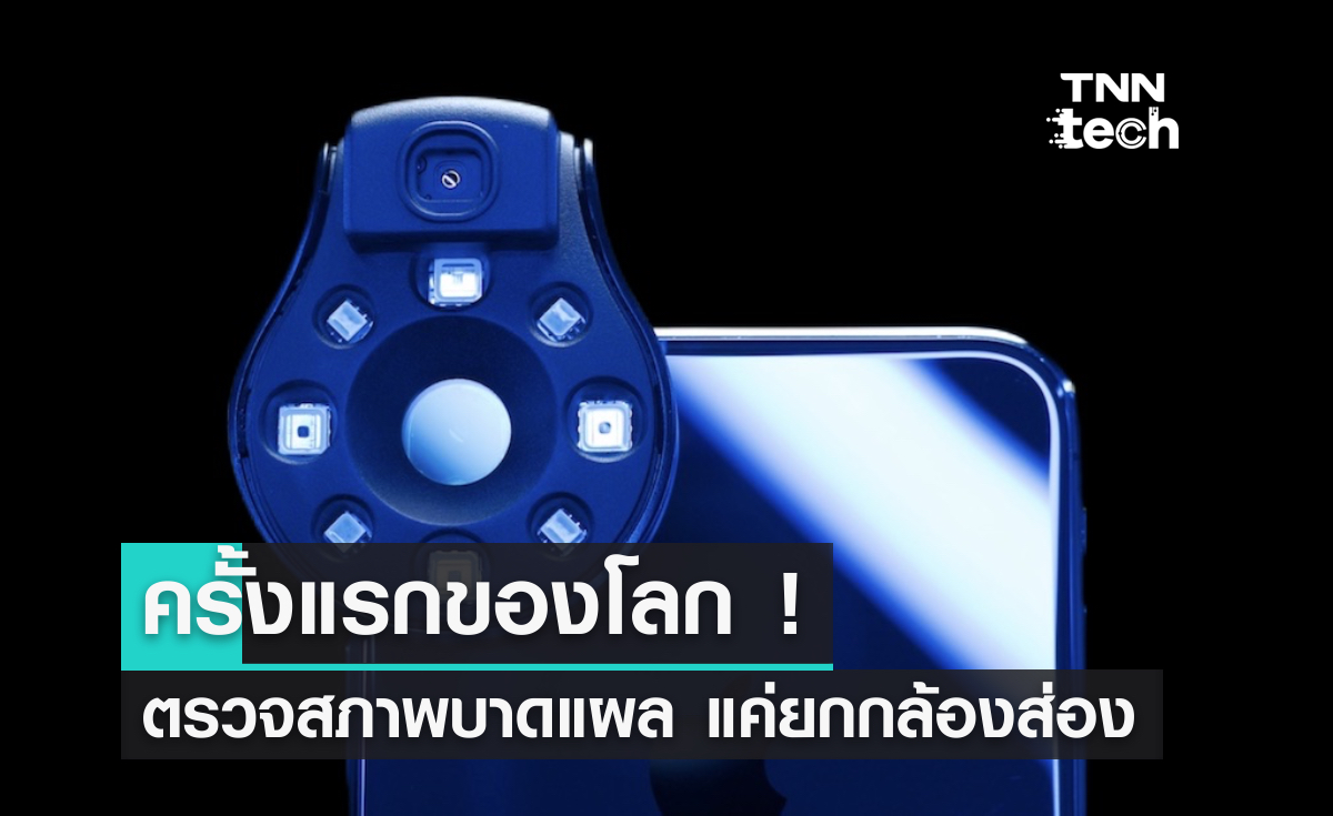 ครั้งแรกของโลก ! ตรวจสภาพบาดแผล แค่ยกมือถือส่อง