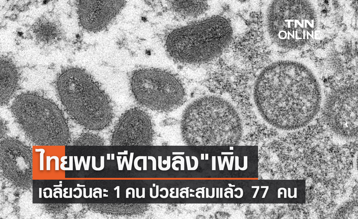 ไทยพบ"ฝีดาษลิง"เพิ่ม เฉลี่ยวันละ 1 คน ป่วยสะสมแล้ว 77 คน 