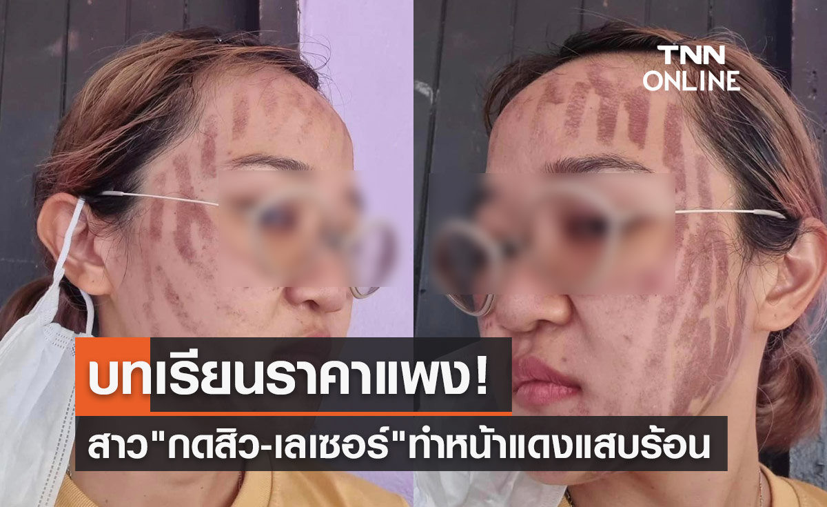สาวโพสต์อุทาหรณ์! เข้าคลินิก "กดสิว-เลเซอร์" สุดท้ายหน้าแดงแสบร้อนผ่าว