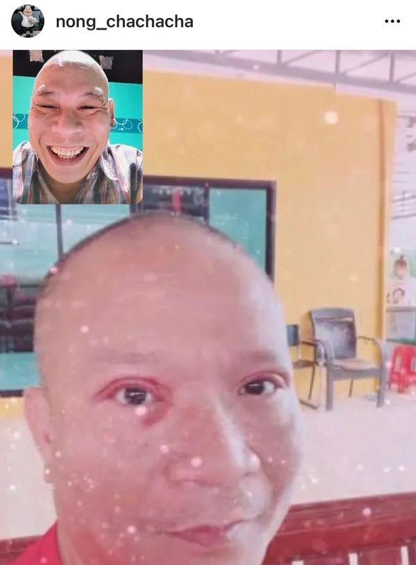 หม่ำ จ๊กมก เผยอาการรักษาหนังตาตก ยังไม่หายดี  ไม่สนคำบูลลี่จากชาวเน็ต! 