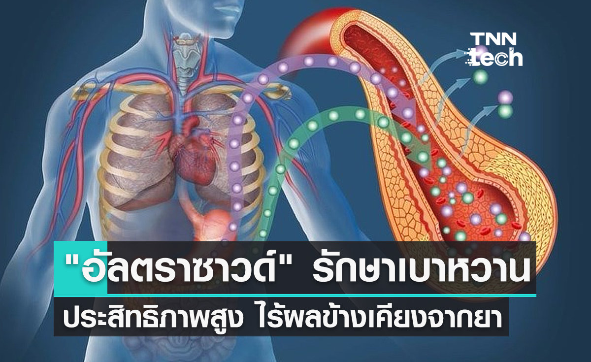 รักษาเบาหวานด้วย "อัลตราซาวด์" ประสิทธิภาพสูง ไร้ผลข้างเคียงจากการใช้ยา 