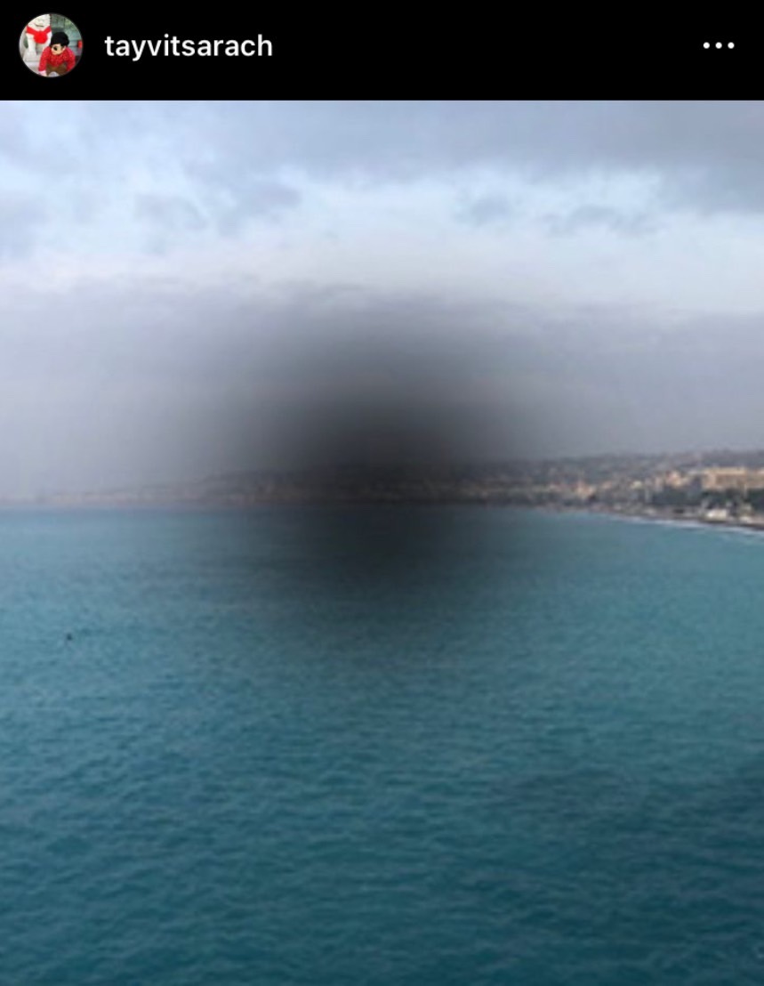 เต้ วิทย์สรัช ป่วยรับปีใหม่ เป็นโรค CSC จอประสาทตาบวม เต้ วิทย์สรัช ป่วยรับปีใหม่ เป็นโรค CSC จอประสาทตาบวม