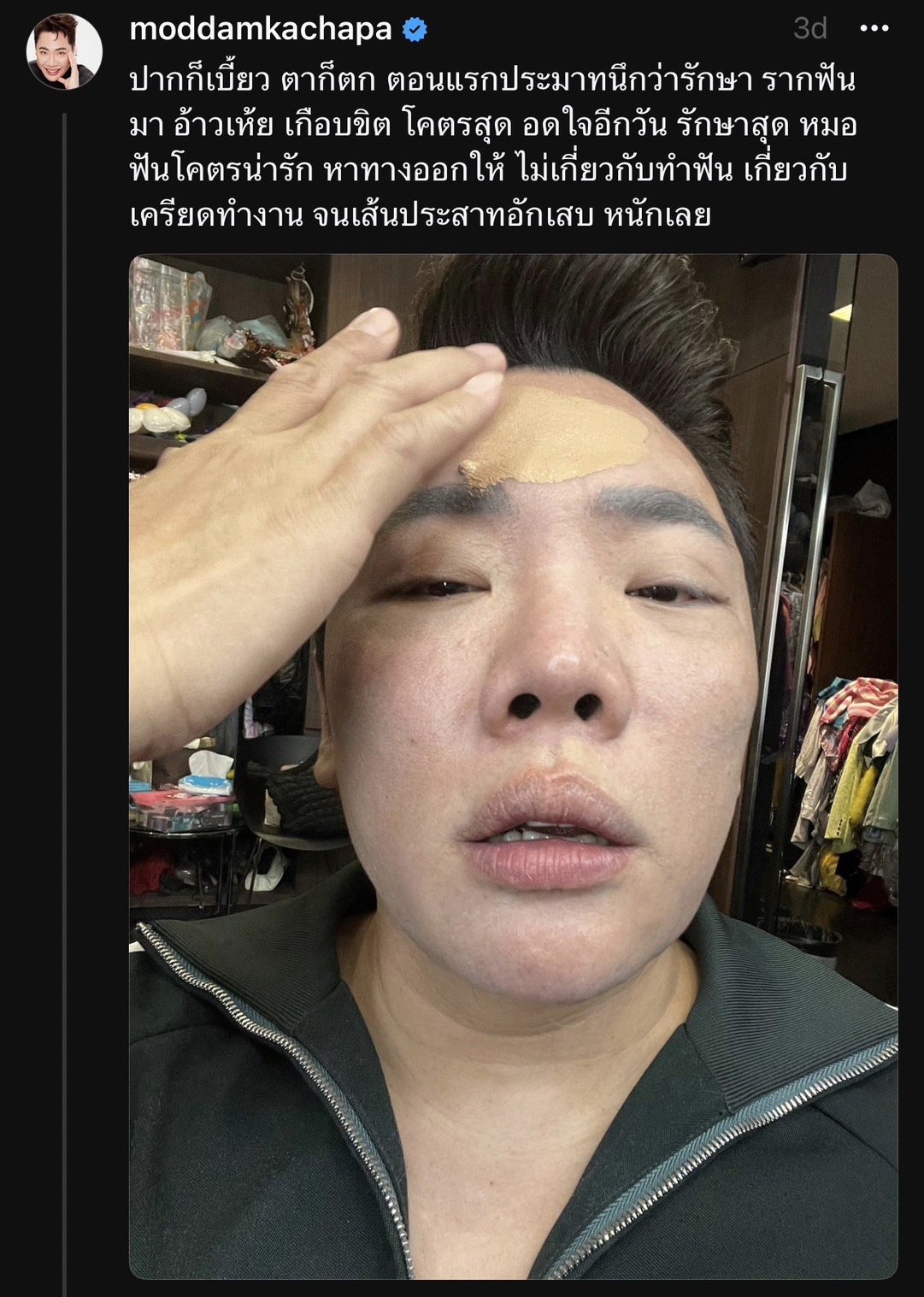 ไม่ยอมทิ้งงาน มดดำ คชาภา อัปเดตอาการปากเบี้ยว ยอมรักษาทุกทาง