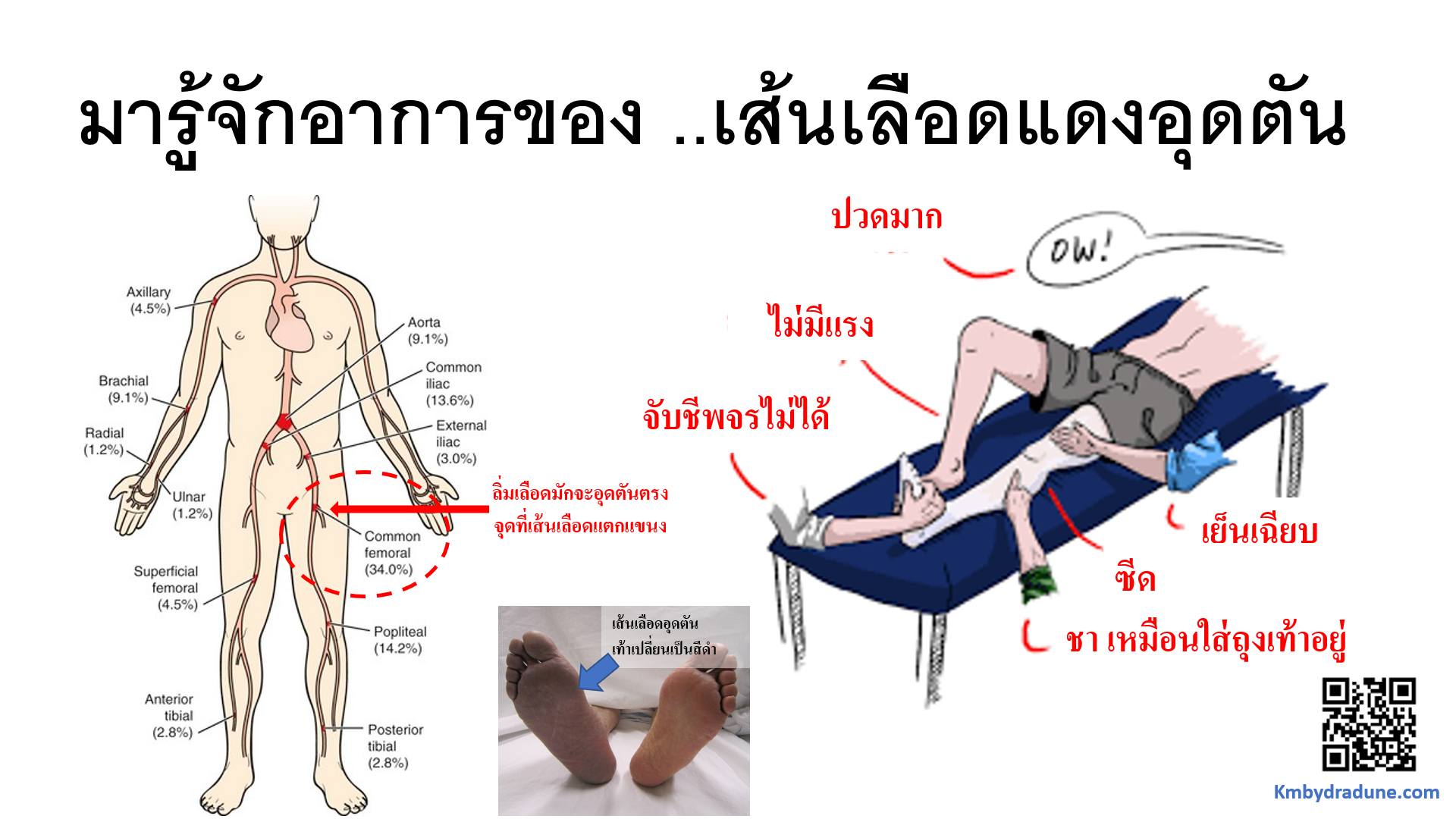 รู้จัก เส้นเลือดแดงอุดตัน เกิดจากอะไร อาการเป็นอย่างไร? 