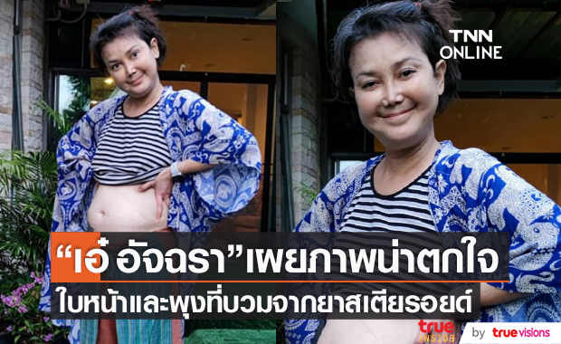 “เอ๋ อัจฉรา ทองเทพ" เผยภาพใบหน้าและพุงที่บวม! จากยาสเตียรอยด์  (มีคลิป)