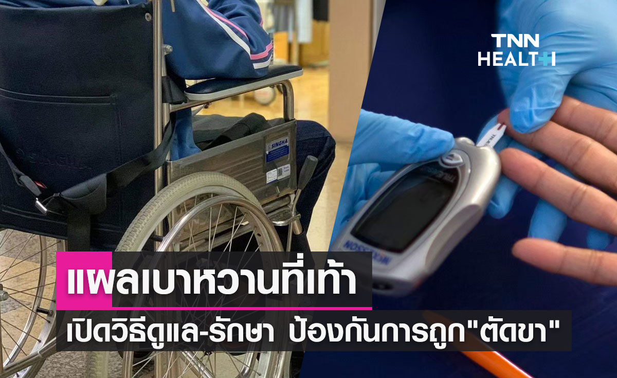 ป่วยเบาหวานต้องรู้! เปิดวิธีดูแลแผลที่เท้า ป้องกันการถูก "ตัดขา"  