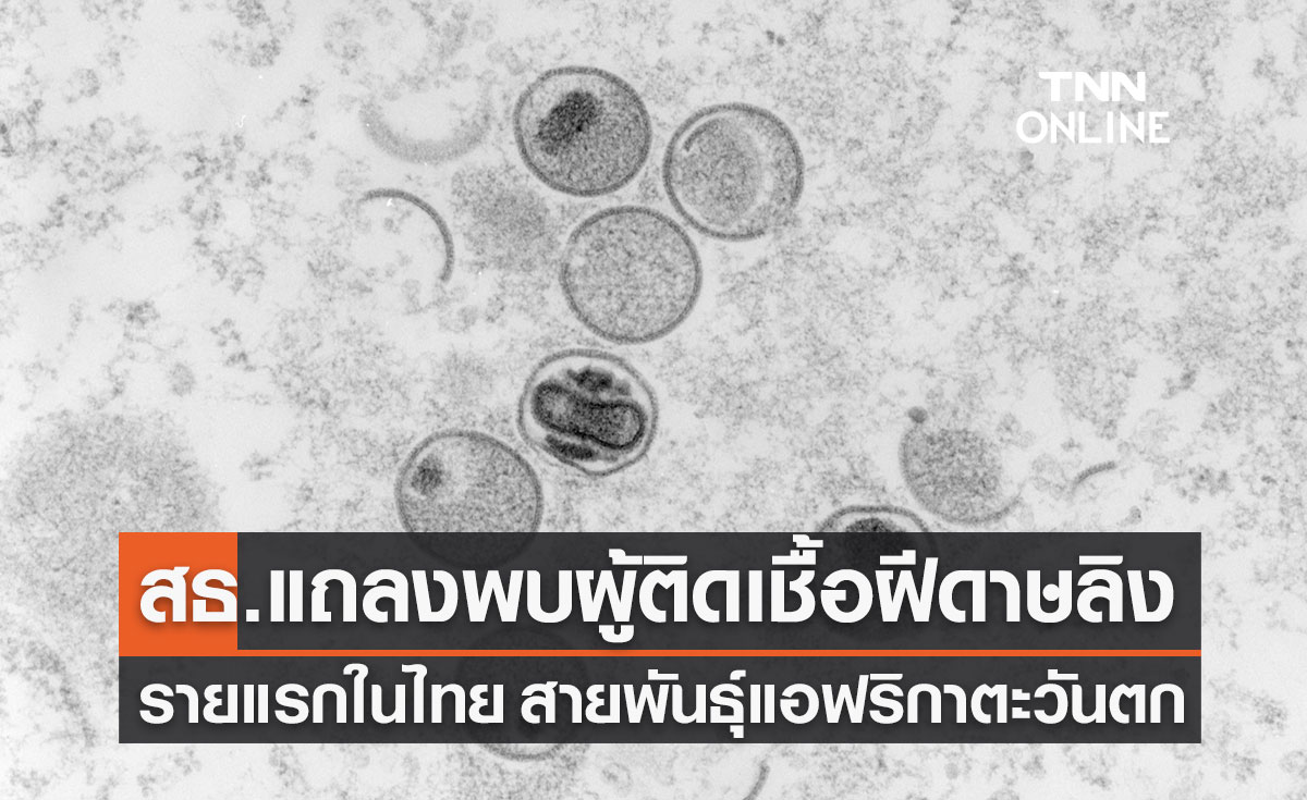 "โรคฝีดาษลิง" รายแรกในไทย เป็นสายพันธุ์แอฟริกาตะวันตก สัมผัสเสี่ยงสูง 2 ราย