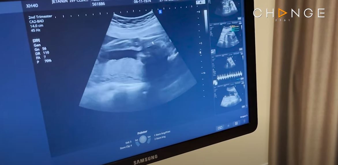 อั๋น ภูวนาท เฉลยเพศลูกคนที่ 2 แล้ว ได้ลูกชาย! พร้อมแจงสาเหตุปิดข่าวท้อง