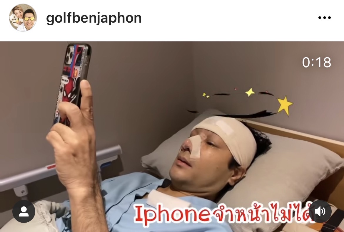 กอล์ฟ เบญจพล อัปเดตหลังเสริมหล่อ ถูกโทรศัพท์แกงหนัก จำหน้าไม่ได้?!  