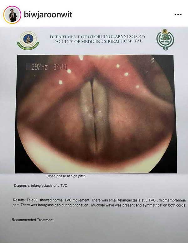 บิว เดอะวอยซ์ ช็อก!รับรู้ข่าวร้าย อาจร้องเพลงไม่ได้อีก เพราะร้องเพลงแบบผิดๆ บิว เดอะวอยซ์ ช็อก!รับรู้ข่าวร้าย อาจร้องเพลงไม่ได้อีก เพราะร้องเพลงแบบผิดๆ