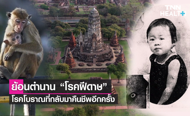 ประวัติฝีดาษและโรคฝีดาษลิงในไทย ย้อนตำนานฝีดาษ โรคโบราณที่คืนชีพอีกครั้ง