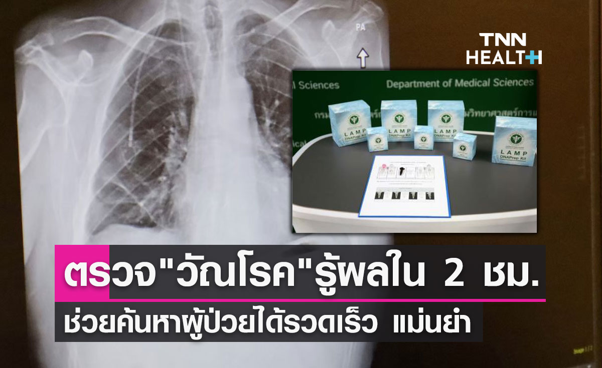 กรมวิทย์ฯถ่ายทอดการผลิตชุดตรวจเชื้อ "วัณโรค" ให้เอกชน รู้ผลใน 2 ชั่วโมง
