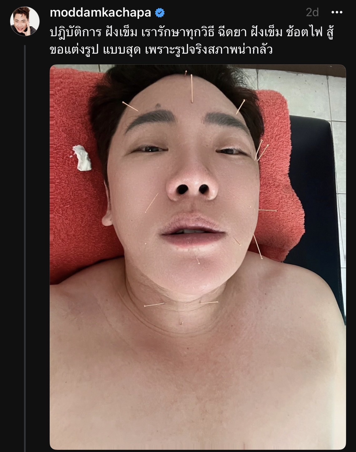 ไม่ยอมทิ้งงาน มดดำ คชาภา อัปเดตอาการปากเบี้ยว ยอมรักษาทุกทาง