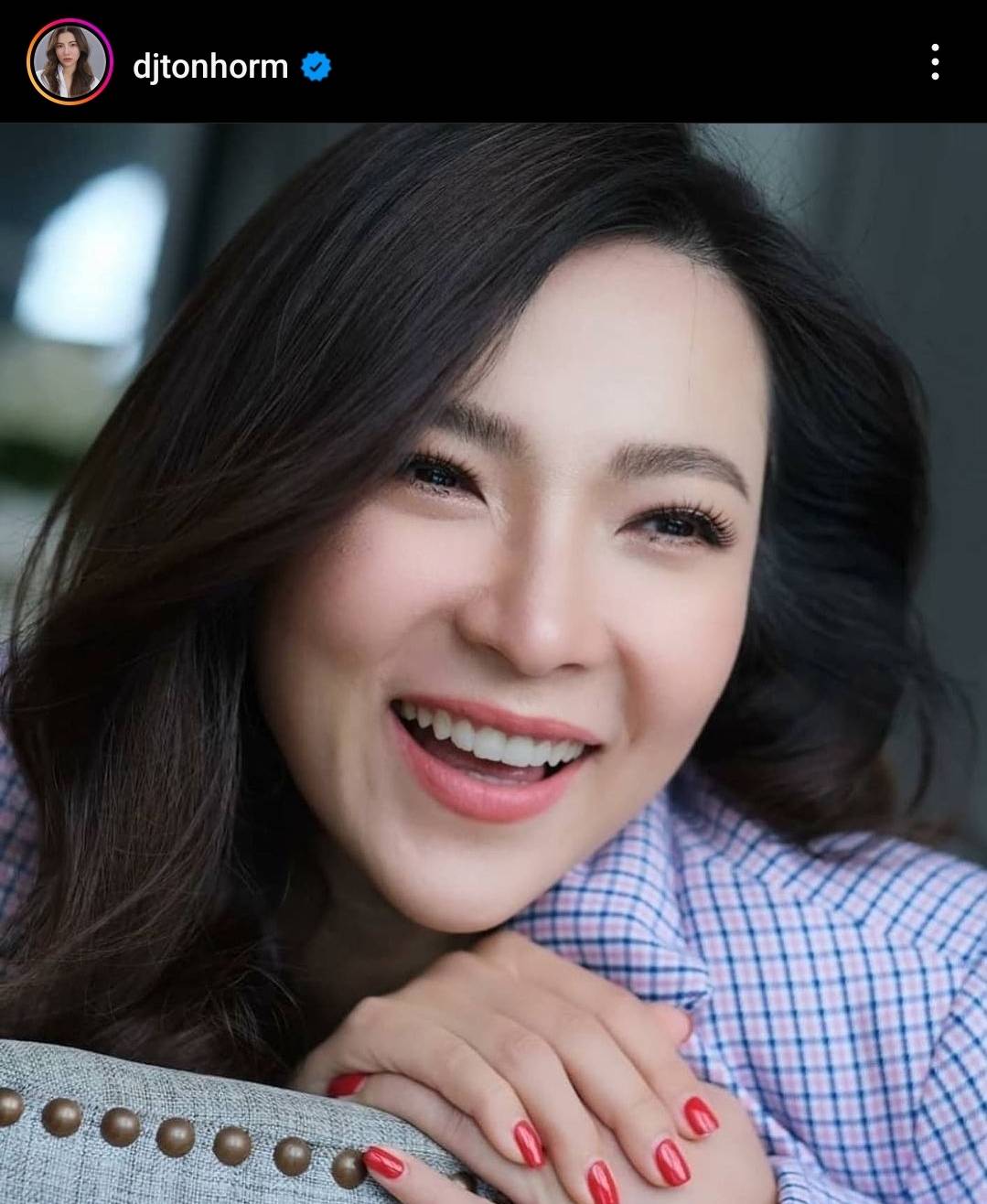 ต้นหอม เผชิญโรคผิวหนังนาน 10 ปี ที่พบได้เพียง 1 ใน 3 แสนคน