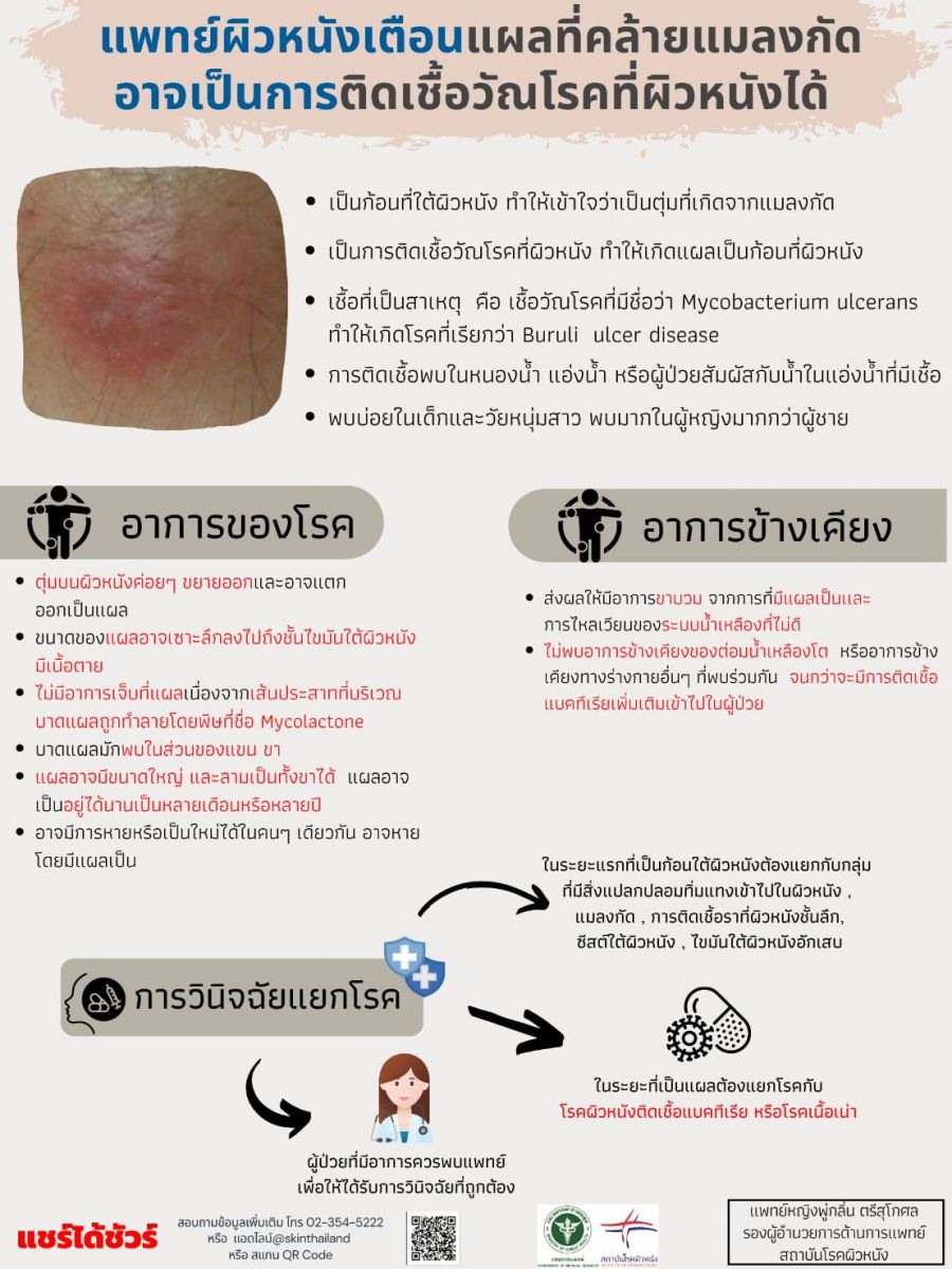 แพทย์ผิวหนังเตือน! แผลที่คล้ายแมลงกัด อาจเป็นการติดเชื้อวัณโรคที่ผิวหนังได้ แพทย์ผิวหนังเตือน! แผลที่คล้ายแมลงกัด อาจเป็นการติดเชื้อวัณโรคที่ผิวหนังได้