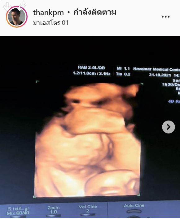 ดีใจหนักมาก แต๊งค์ พงศกร  เปิดภาพอัลตร้าซาวด์ลูกชาย เผย อีก 4 สัปดาห์จะเจอกันเเล้ว