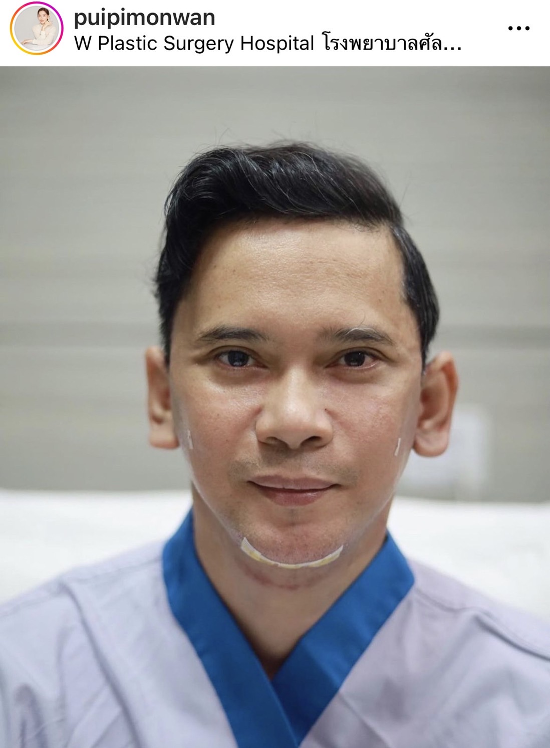 แมว จิรศักดิ์ ตอบสุดฮา หลังทำศัลยกรรมครั้งแรก บอกตัวเองชื่อ ณเดชน์