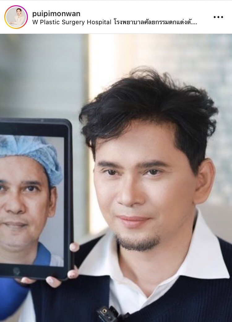 หล่อสมใจ! เปิดภาพ แมว จิรศักดิ์ หลังทำศัลยกรรม 20 วัน ลั่นนี่น้าแมวไม่ใช่ณเดชน์นะ 