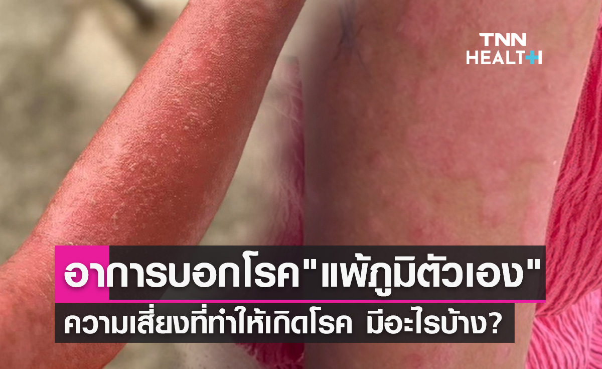 ความเสี่ยงที่ทำให้เกิด โรคพุ่มพวง หรือ โรคแพ้ภูมิตัวเอง 