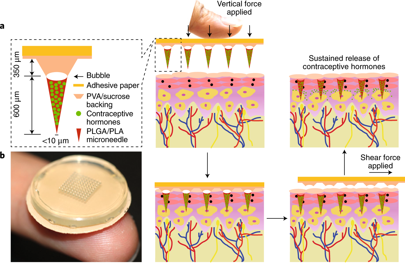 Microneedle ทางออกใหม่ในการรักษาแผลติดเชื้อเรื้อรัง Microneedle ทางออกใหม่ในการรักษาแผลติดเชื้อเรื้อรัง
