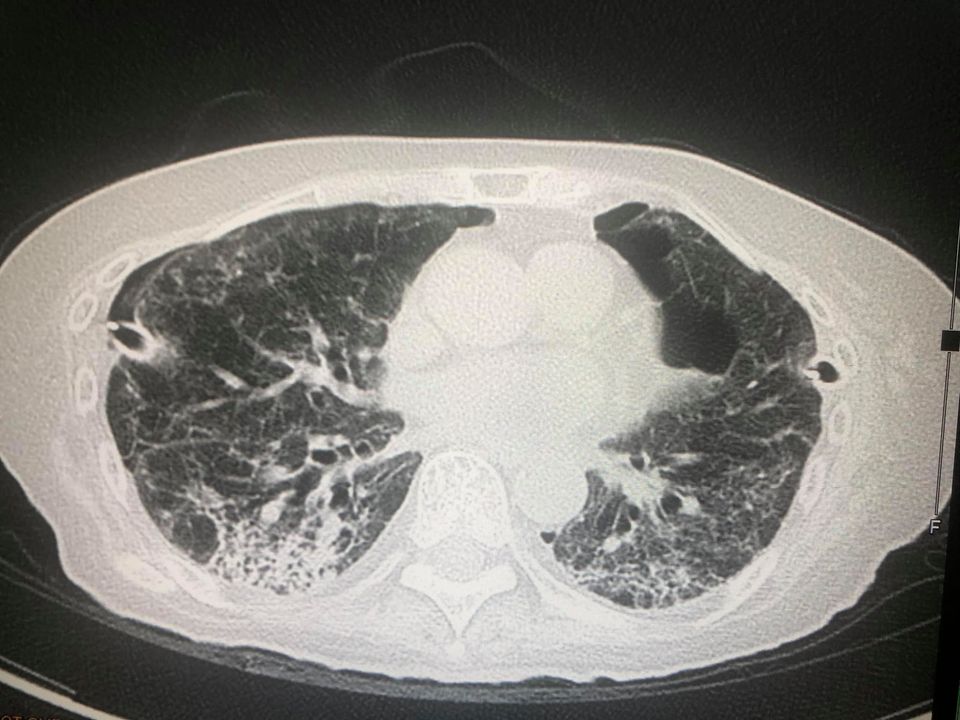 หมอมนูญ เปิดภาพเอ็กซเรย์ปอดผู้ป่วยโควิด ยังไม่ได้ฉีดวัคซีน ปอดรั่วทั้ง 2 ข้าง หมอมนูญ เปิดภาพเอ็กซเรย์ปอดผู้ป่วยโควิด ยังไม่ได้ฉีดวัคซีน ปอดรั่วทั้ง 2 ข้าง