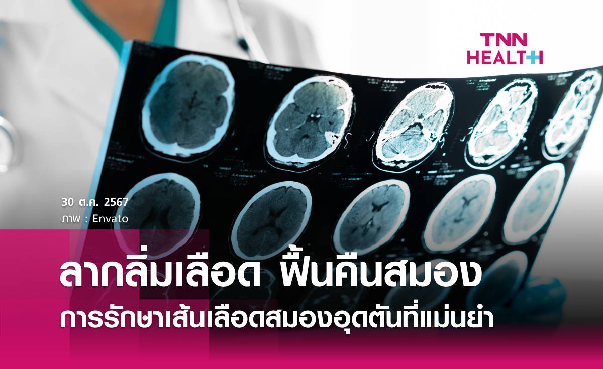 ลากลิ่มเลือด ฟื้นคืนสมอง การรักษาเส้นเลือดสมองอุดตันที่แม่นยำ
