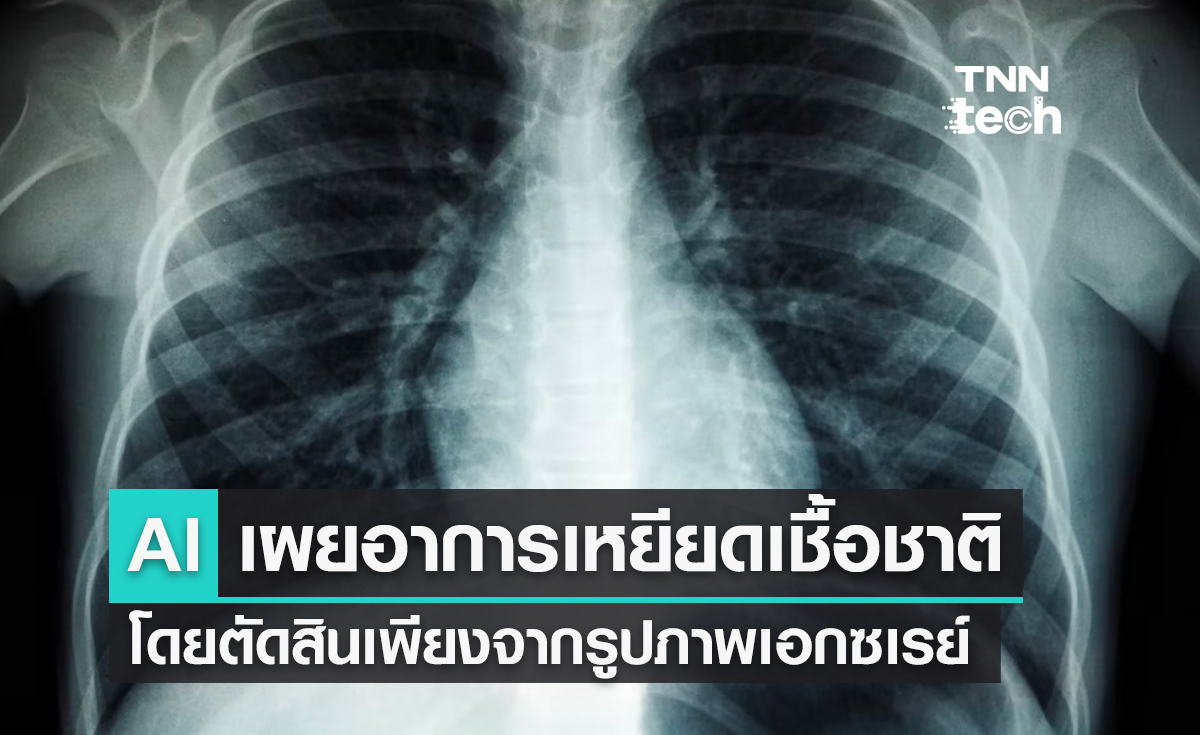วิจัยเผย AI แสดงถึงอคติทางเชื้อชาติได้อย่างแม่นยำ โดยวิเคราะห์จากรูปภาพเอกซเรย์