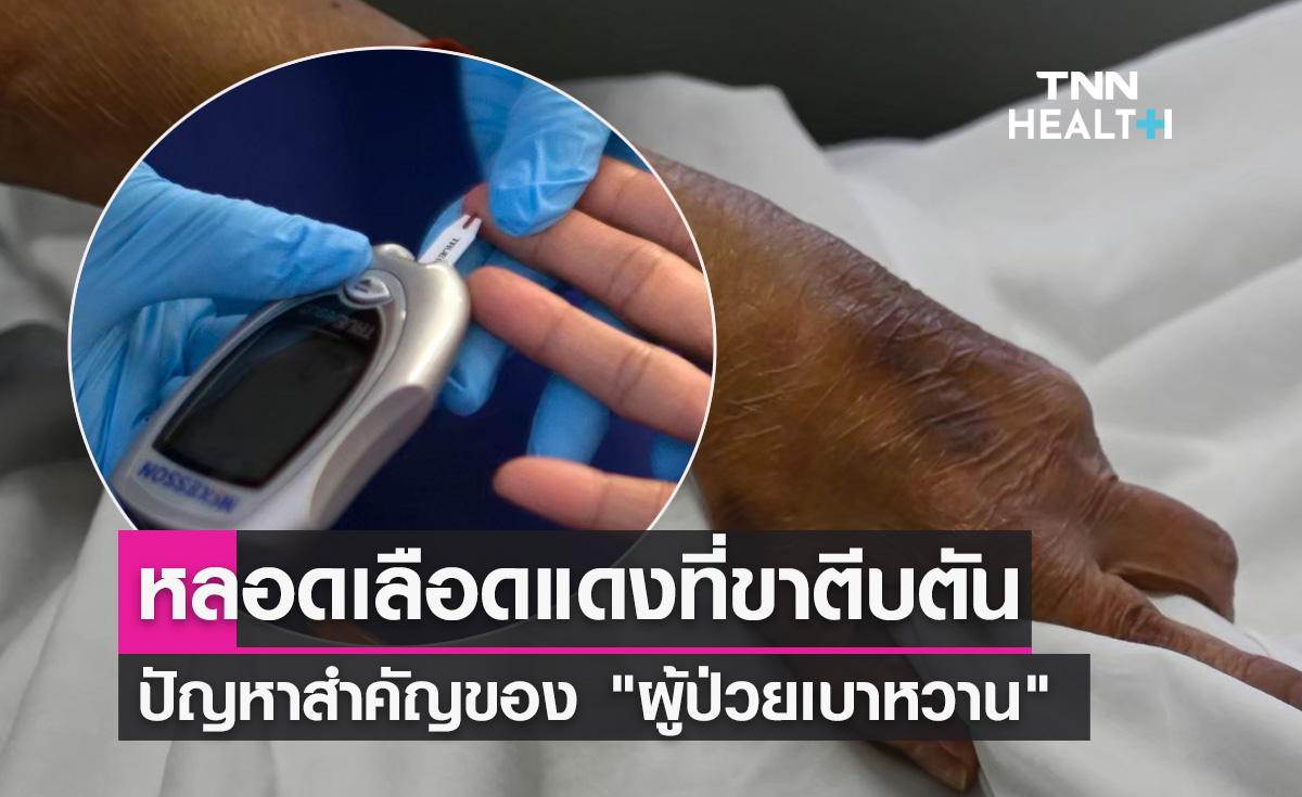รู้จัก "โรคหลอดเลือดหัวใจตีบ" ปัญหาสำคัญของ "ผู้ป่วยเบาหวาน"