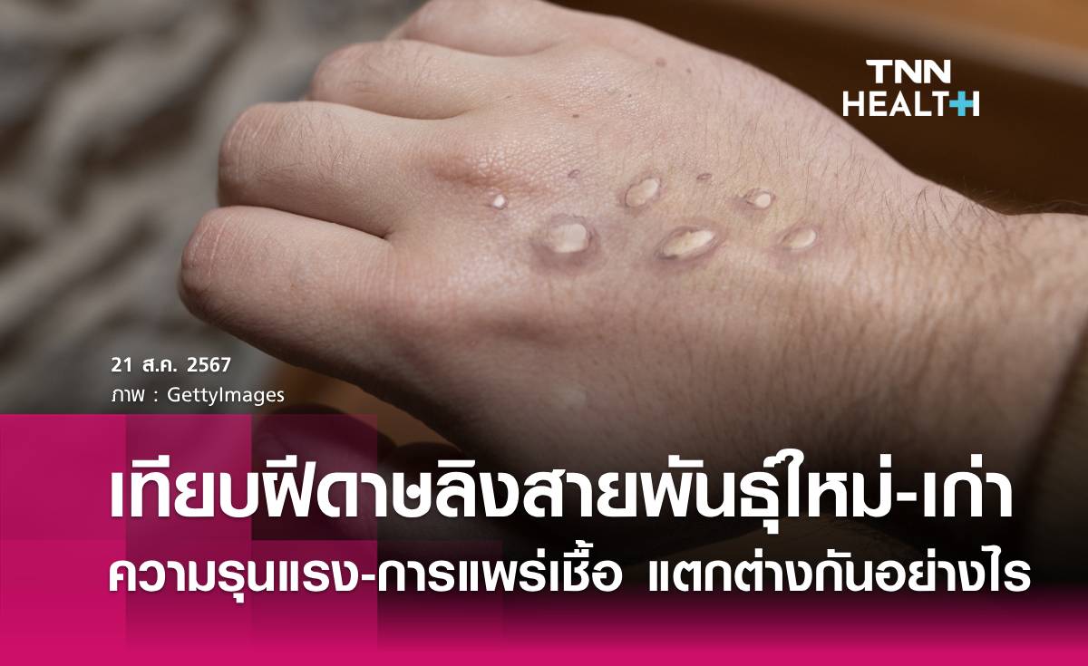 "ฝีดาษลิง" สายพันธุ์ใหม่ - เก่า แตกต่างกันอย่างไร?