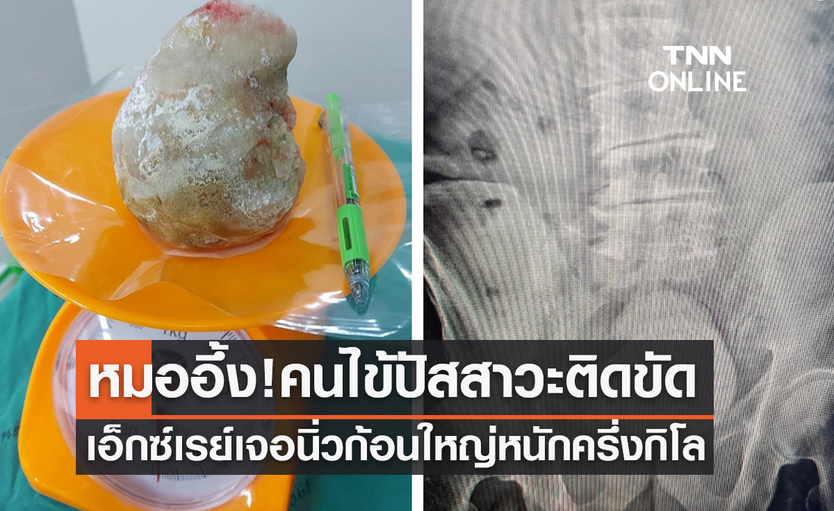 หมออึ้ง! ผู้ป่วยปัสสาวะติดขัดเจอนิ่วก้อนใหญ่หนักครึ่งกิโล