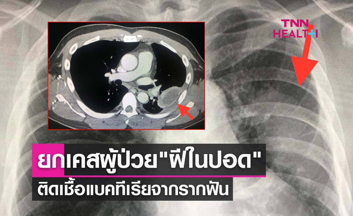 อย่ามองข้าม! ยกเคสผู้ป่วย "ฝีในปอด" ติดเชื้อแบคทีเรียจากรากฟัน
