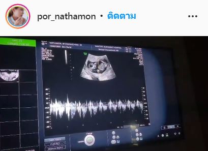 ตั้งท้อง 3 เดือน!! อดีตนักร้อง วงแจมป์ ปอ ณฐมน ประกาศข่าวดีแล้ว