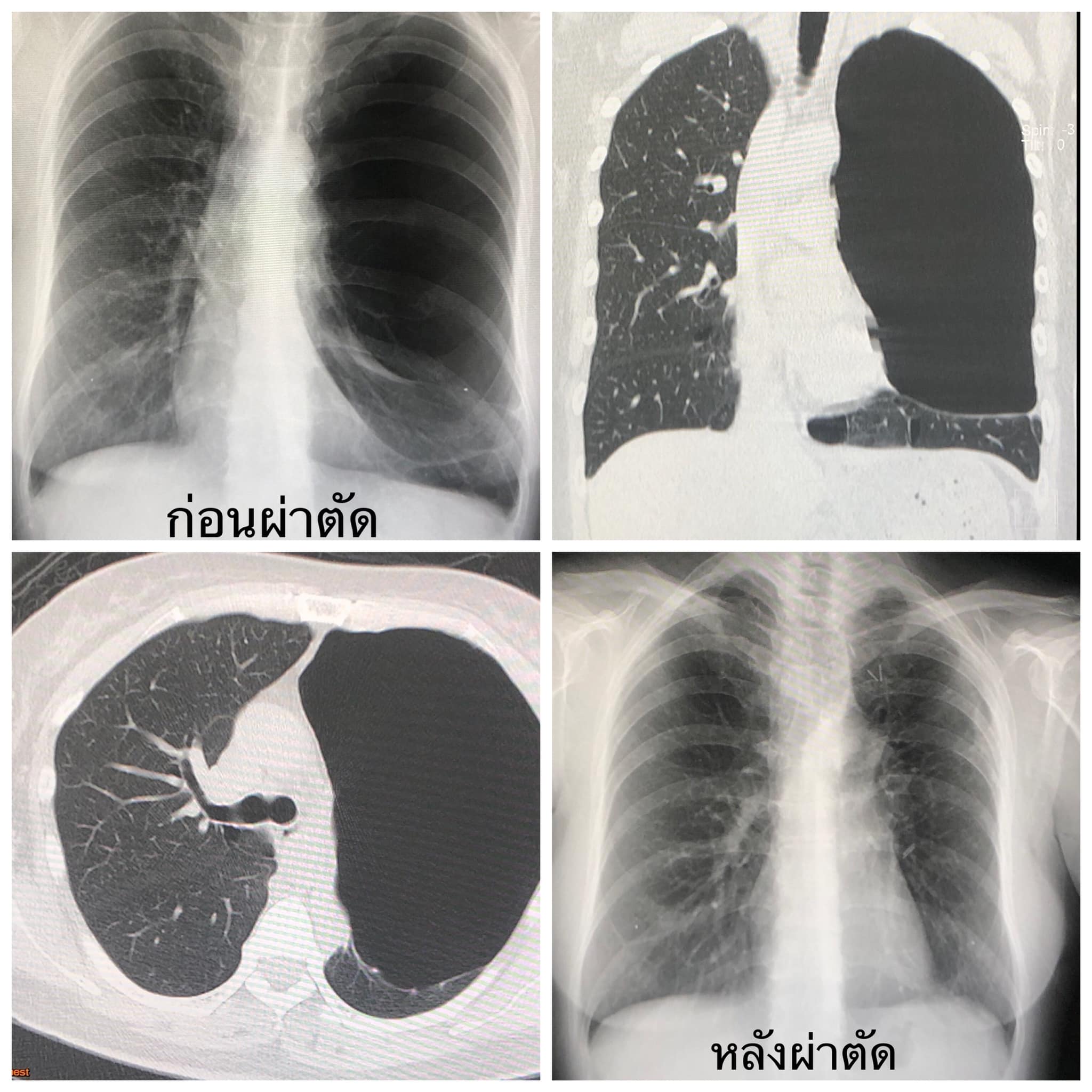 หมอมนูญเผยเคส ‘ถุงลมโป่งพอง’ แม้ไม่สูบบุหรี่ เจออาการแบบนี้ควรพบแพทย์